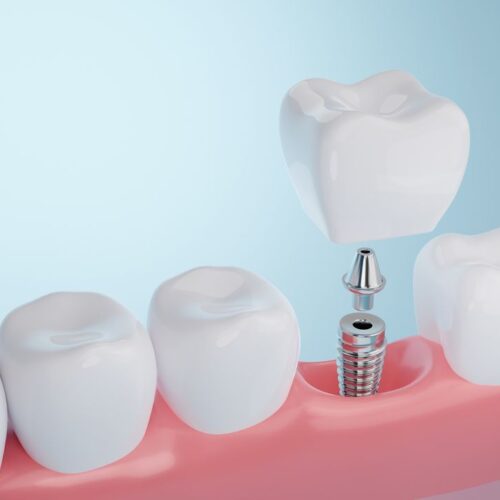 Dental implant